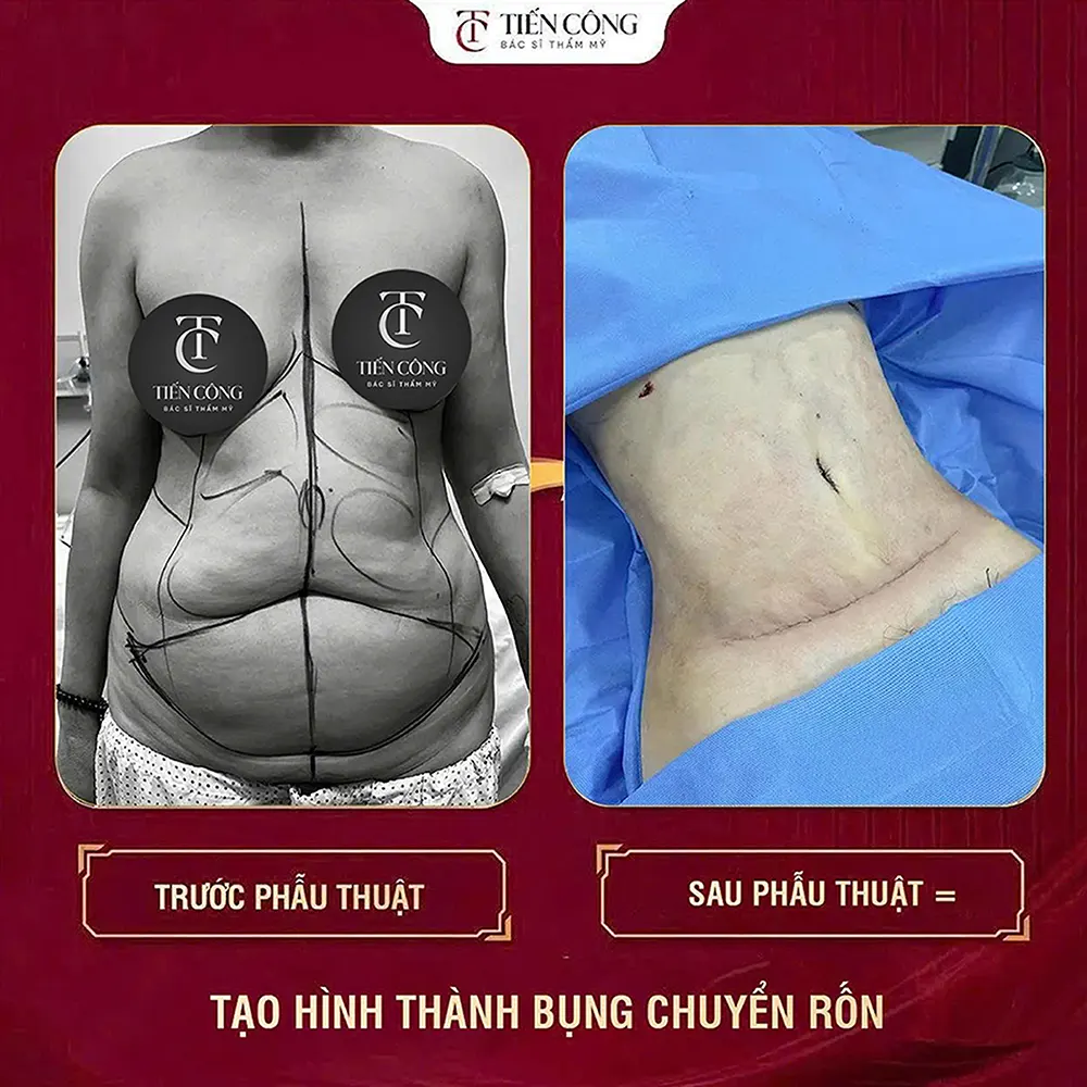 TẠO HÌNH THÀNH BỤNG: TÁI ĐỊNH HÌNH VÒNG EO – CÂN ĐỐI VÀ GỌN GÀNG
