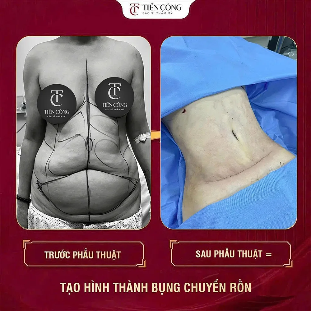 TẠO HÌNH THÀNH BỤNG: TÁI ĐỊNH HÌNH VÒNG EO – CÂN ĐỐI VÀ GỌN GÀNG